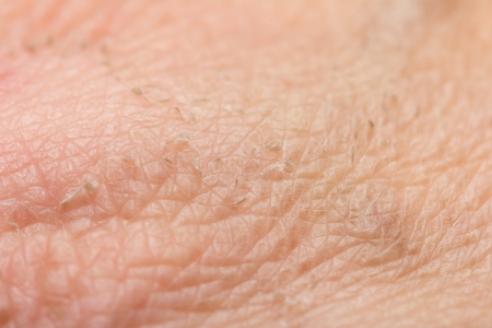 traces of burns on the skin. macroの写真素材