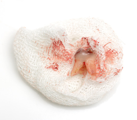 pull teeth with blood. macroの写真素材