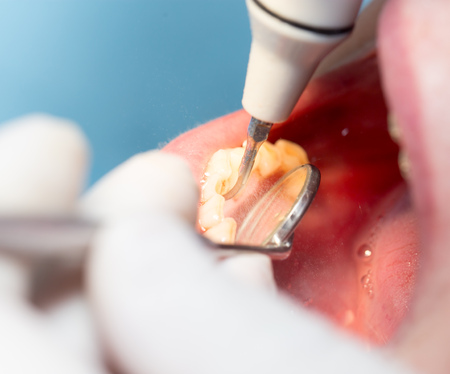 dental treatment in dentistryの写真素材