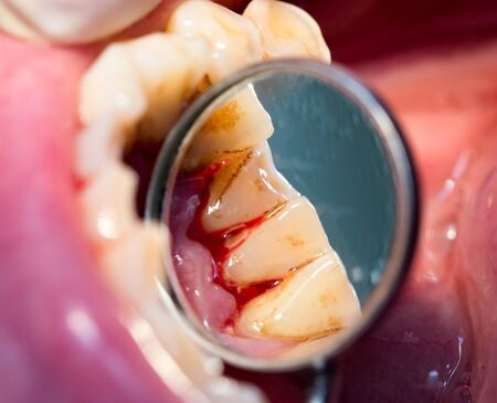 dental treatment in dentistryの写真素材