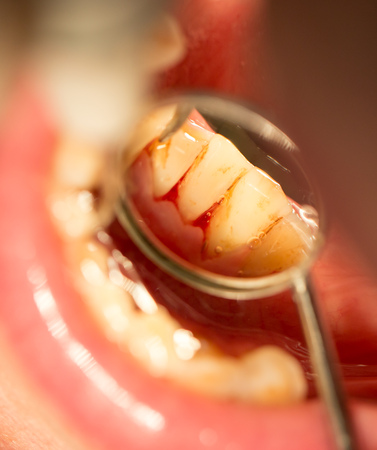 dental treatment in dentistryの写真素材
