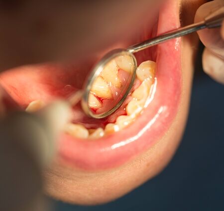 dental treatment in dentistryの写真素材
