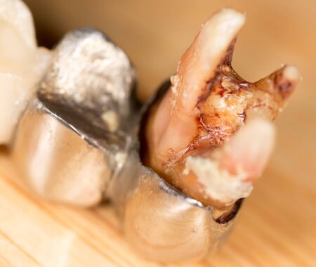 metal tooth. macro