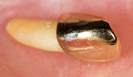 metal tooth. macroの写真素材