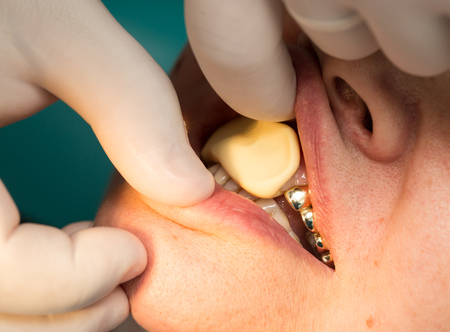 doctor makes a plastic prosthetic dentistry