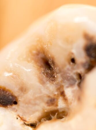 A tooth torn by a doctor in dentistryの写真素材