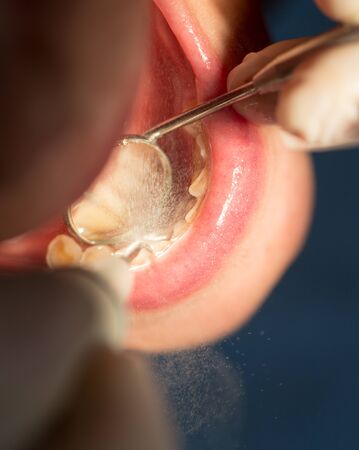 Doctor performs an operation on teeth in dentistryの写真素材