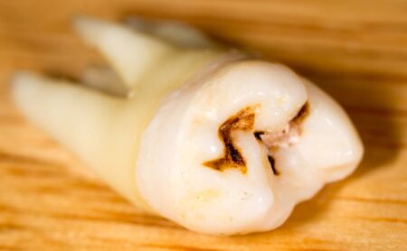 A tooth torn by a doctor in dentistry