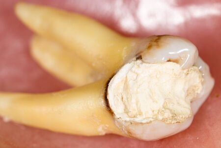 A tooth torn by a doctor in dentistryの写真素材