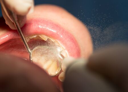Doctor performs an operation on teeth in dentistryの写真素材