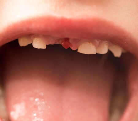 The mouth of a boy without a tooth .