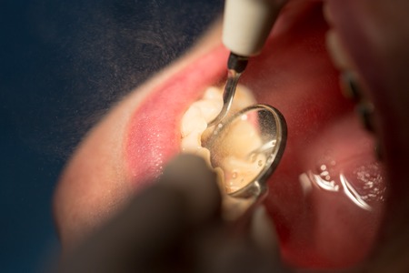 Doctor performs an operation on teeth in dentistryの写真素材