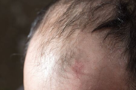 Bald head on a man's head as a background .の写真素材