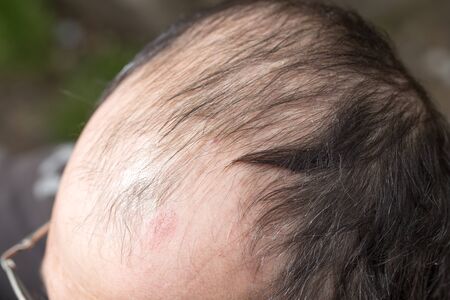 Bald head on a man's head as a background .の写真素材