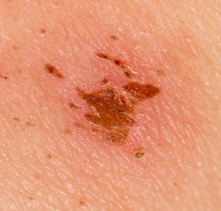 Wound on the skin of a person. macro
