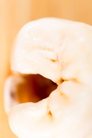 Caries on the teeth of a manの写真素材