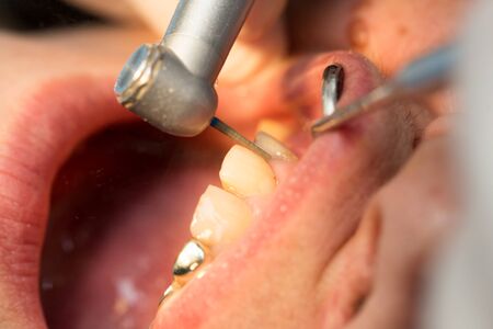 A dentist makes teeth to a woman .の写真素材