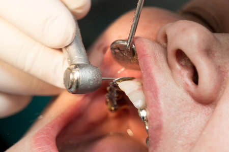 A dentist makes teeth to a woman .の写真素材
