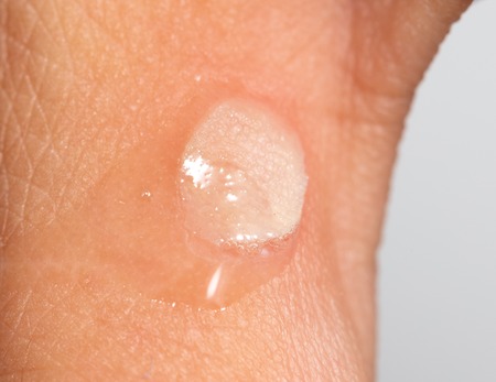 Hydrogen peroxide on corn on the skin .