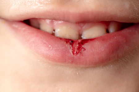 Blood on the boy's lip. Macroの写真素材
