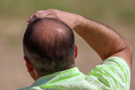 Bald head on a man's head with testosterone.の写真素材