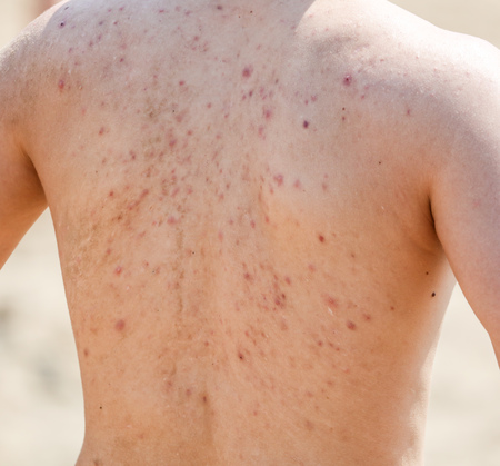 Man with acne on his back.の写真素材
