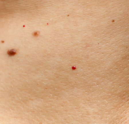 Birthmarks on the skin as a background.の写真素材
