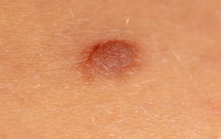 Birthmark on human skin as a background. Macro photoの写真素材
