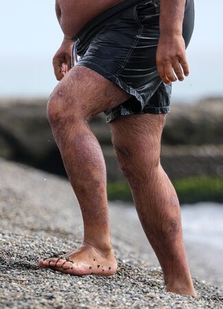 Legs with spots of a man burned in the sun. Relax on the sea beachの写真素材