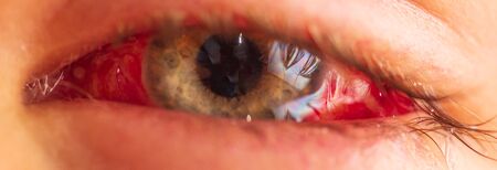 Red blood eye after surgeryRed blood eye after surgery. Macro
