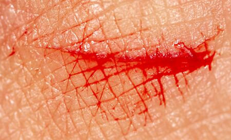 Close-up of blood from a wound on a human skin. Macro