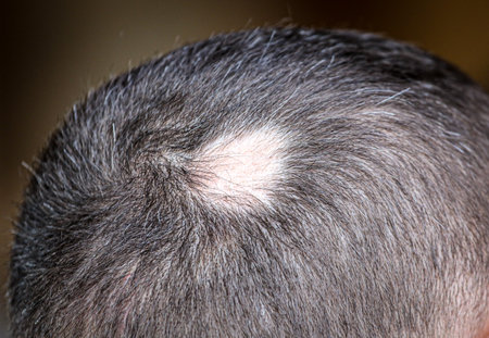A receding hairline on a man's head. Hairstyleの写真素材
