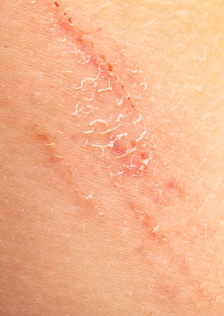 Wound scar on human skin. Close-up