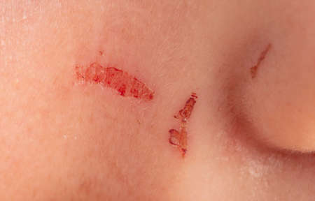 Close-up wound on human skin. Macroの写真素材