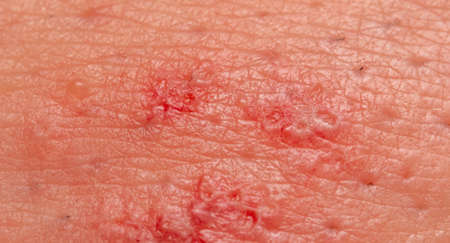 Close-up of a wound with pus on human skin. Macroの写真素材