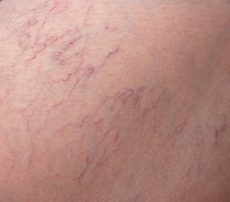 Veins on a woman's leg. close-upの写真素材