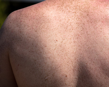 Freckle on the back of a man. backgroundの写真素材