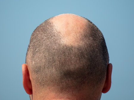 Bald patch on a man's head against a blue sky.
