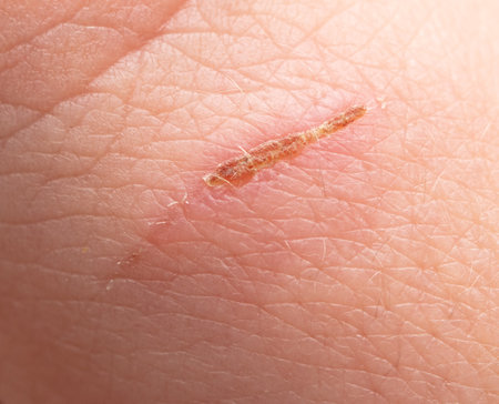 Wound on human skin. Macroの写真素材