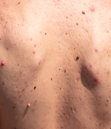 The back of a man with acne as a background.の写真素材