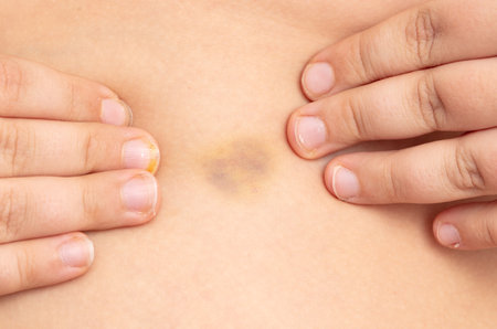 Close-up of a bruise on a person's skin.の写真素材