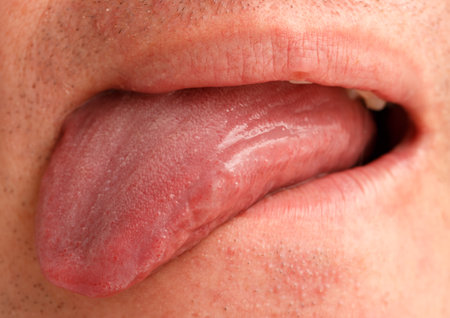 A man's tongue is red and swollen. The tongue is hanging out of his mouthの写真素材