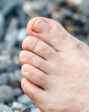 A man's foot with a nail on it. The nail is yellow and has a brown tip