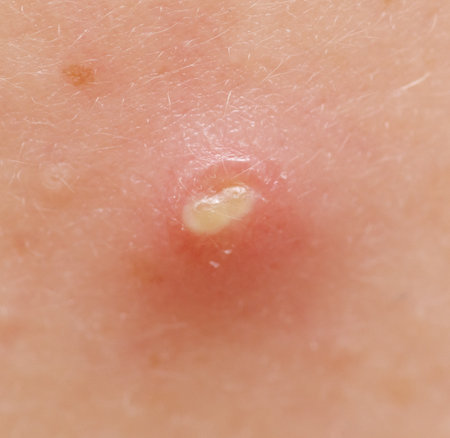 A red bump on a person's arm. The bump is yellow and has a white center. It is a pimple