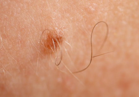 A small mole is on the arm of a person. The mole is brown and has a white centerの写真素材