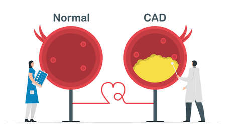 Comparison of Normal heart and Coronary artery disease.Cardiology vector illustration isolated on white background.のイラスト素材