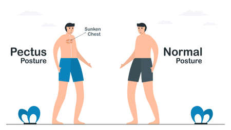 Comparison of normal and pectus posture. Pectus excavatum has a sunken chest. Pulmonology vector illustration about restrictive lung disease.のイラスト素材