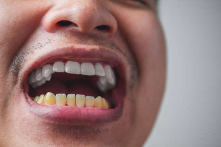 Dental concept. The man is huge smiling. Before and after teeth whitening. Result of oral care after...