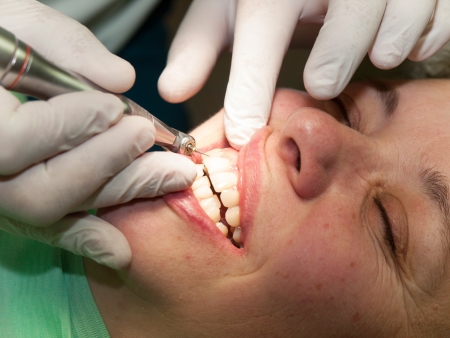 Dentis making dental filling on front toothの写真素材