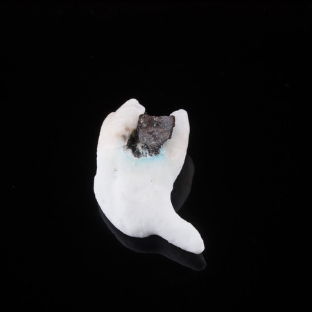 Extracted third molar with amalgam fillingの写真素材